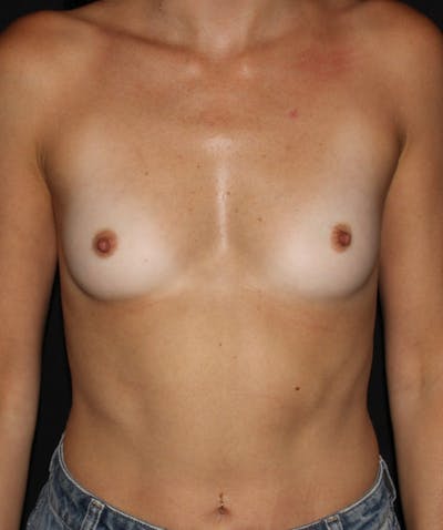 Breast Lift with Implants Before & After Gallery - Patient 157917 - Image 1