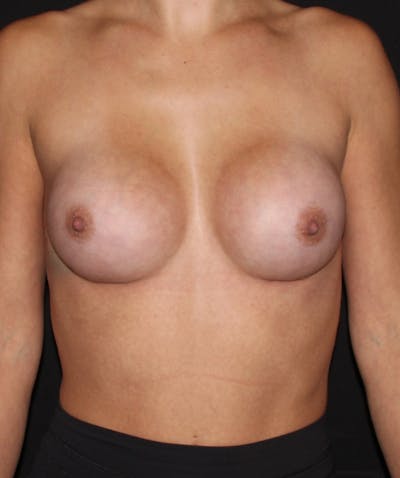 Breast Lift with Implants Before & After Gallery - Patient 149263 - Image 2