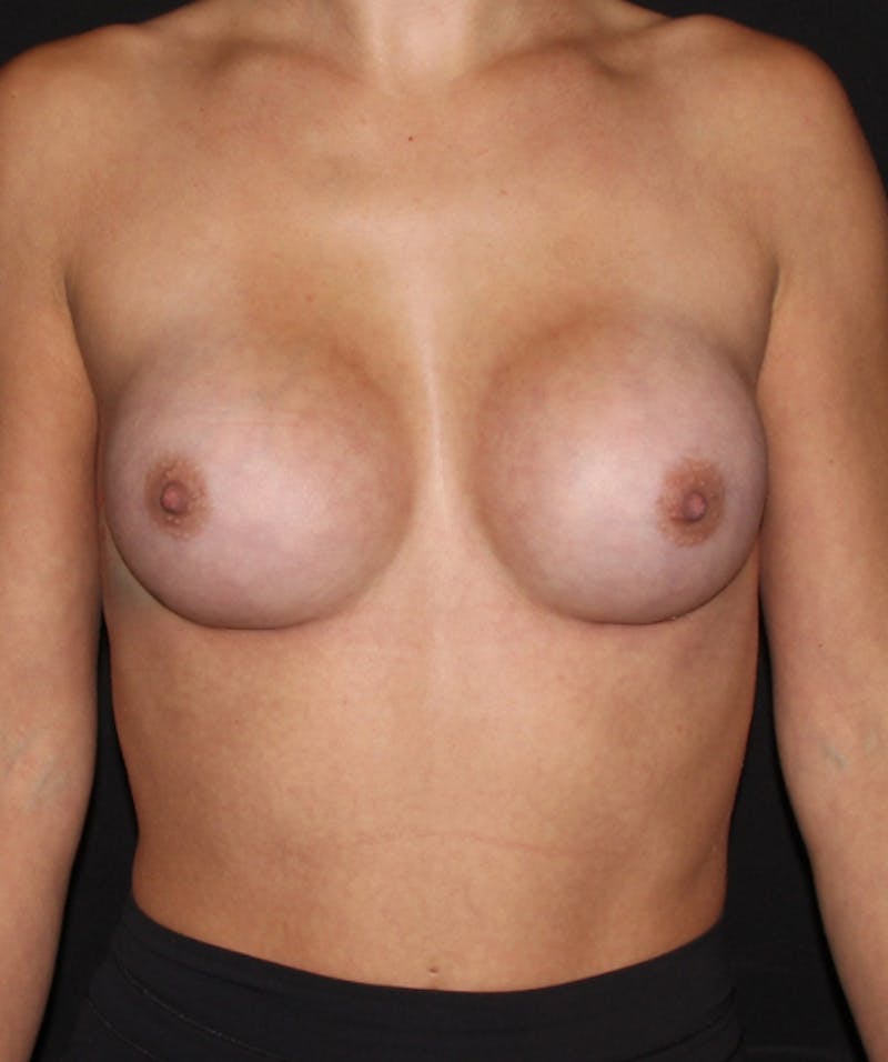 Preservation Breast Augmentation Before & After Gallery - Patient 354014 - Image 2