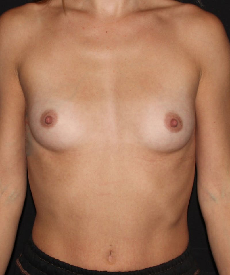 Preservation Breast Augmentation Before & After Gallery - Patient 354014 - Image 1