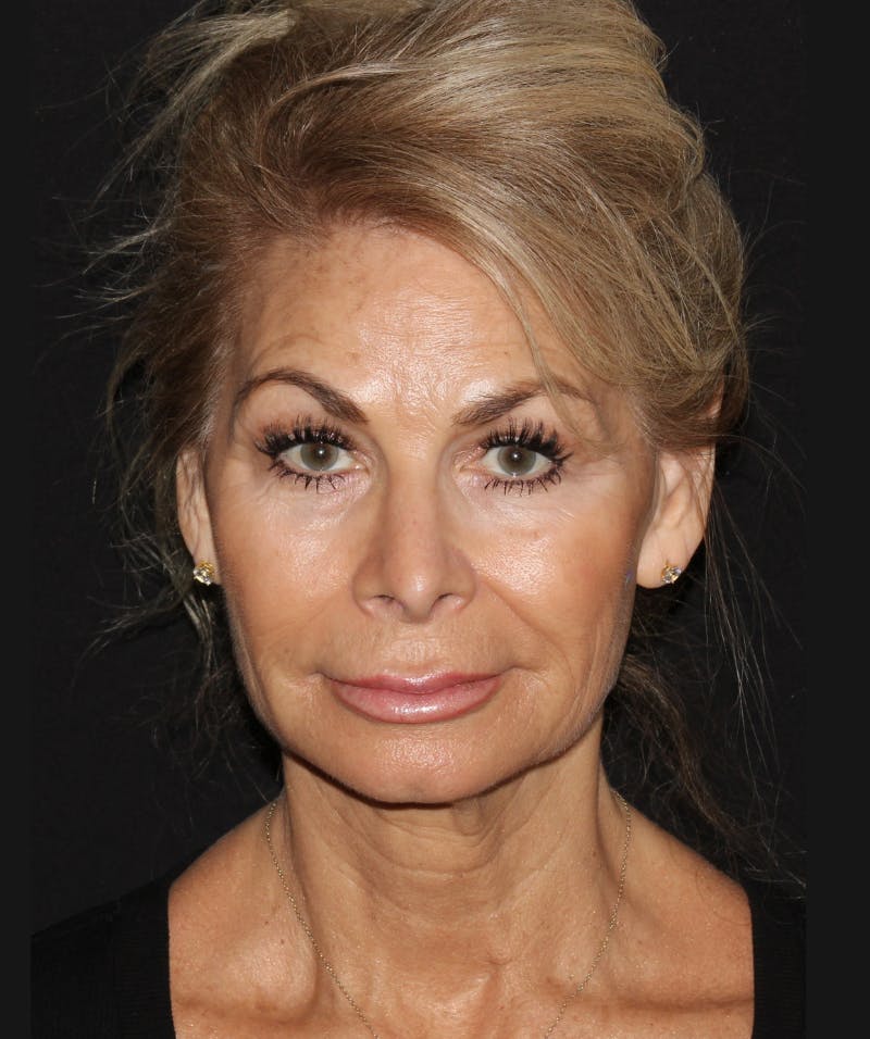 Facelift & Necklift Before & After Gallery - Patient 319285 - Image 1