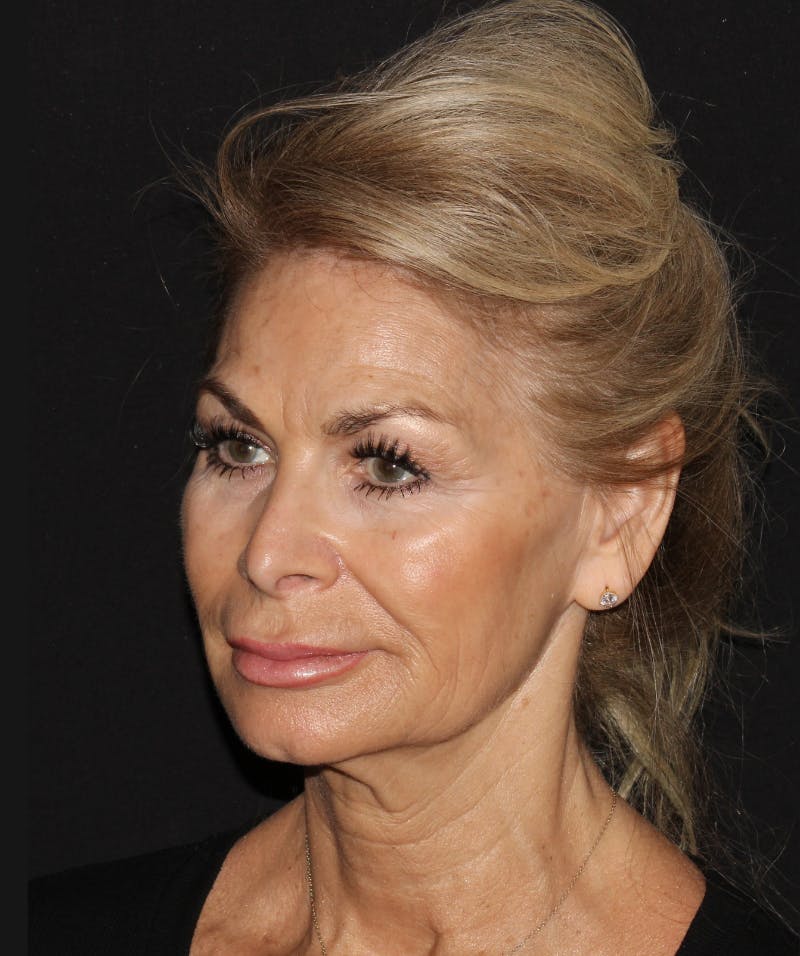 Facelift & Necklift Before & After Gallery - Patient 319285 - Image 3