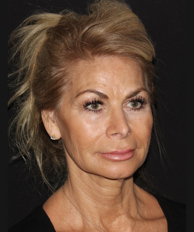 Facelift & Necklift Before & After Gallery - Patient 319285 - Image 6