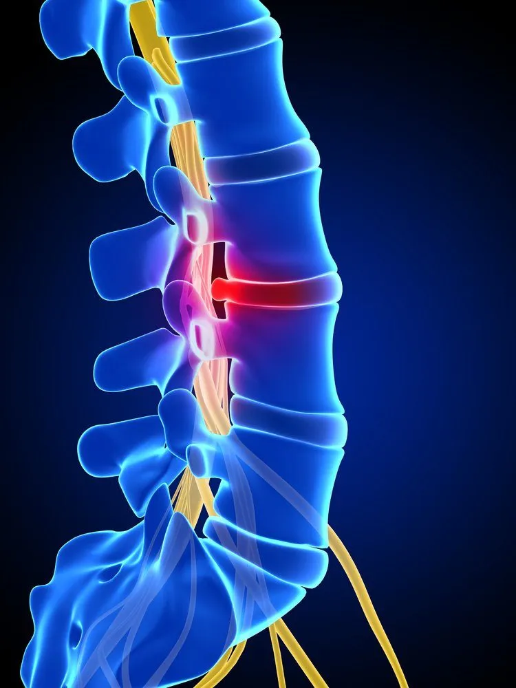 Intervertebral Disc Herniation (IVDH) Chiropractor San Diego CA
