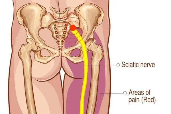 https://www.datocms-assets.com/92982/1676015626-sciatica-low-back-pain-intouch-chiropractic-san-diego-nucca-nonsurgical-spinal-decompression-600x400.webp