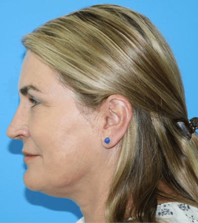 Facelift Before & After Gallery - Patient 119278414 - Image 1