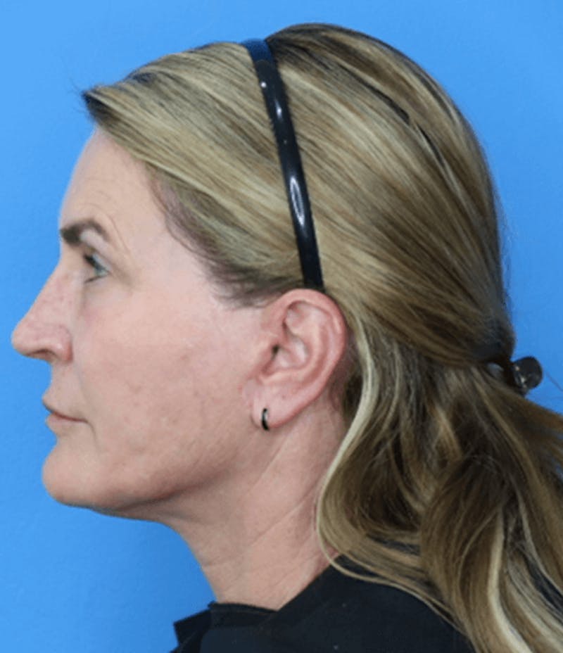 Facelift Before & After Gallery - Patient 119278414 - Image 2