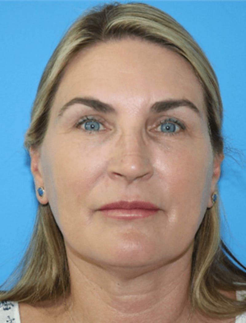 Facelift Before & After Gallery - Patient 119278414 - Image 3