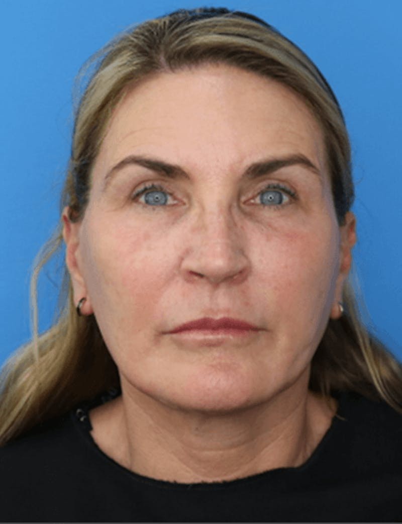 Facelift Before & After Gallery - Patient 119278414 - Image 4