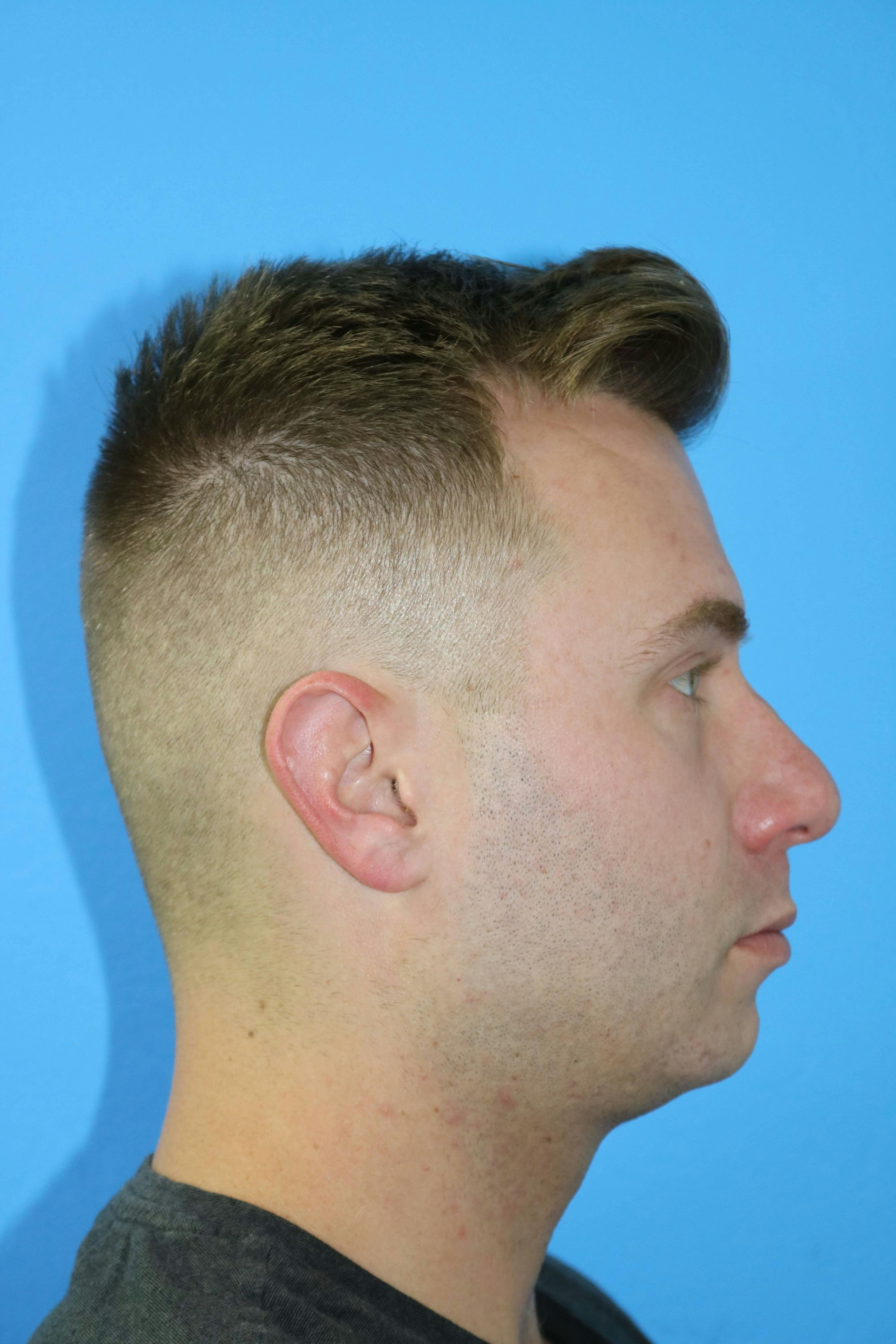 Chin Augmentation