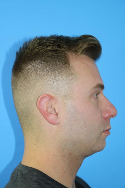 Chin Augmentation Before & After Gallery - Patient 119278777 - Image 1