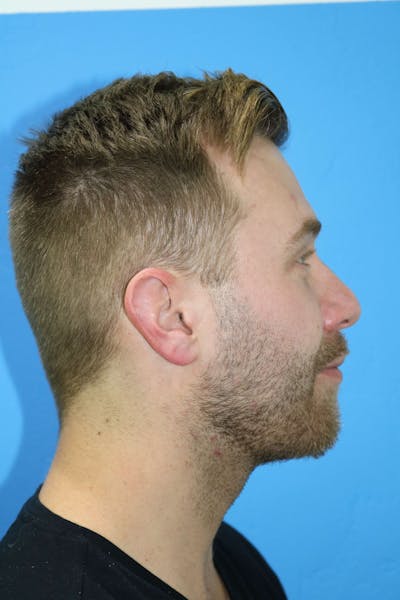 Chin Augmentation Before & After Gallery - Patient 119278777 - Image 2