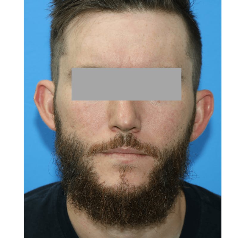 Ear Surgery Before & After Gallery - Patient 119278732 - Image 1