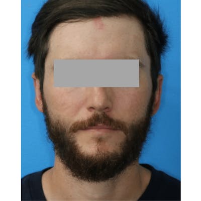 Ear Surgery Before & After Gallery - Patient 119278732 - Image 2