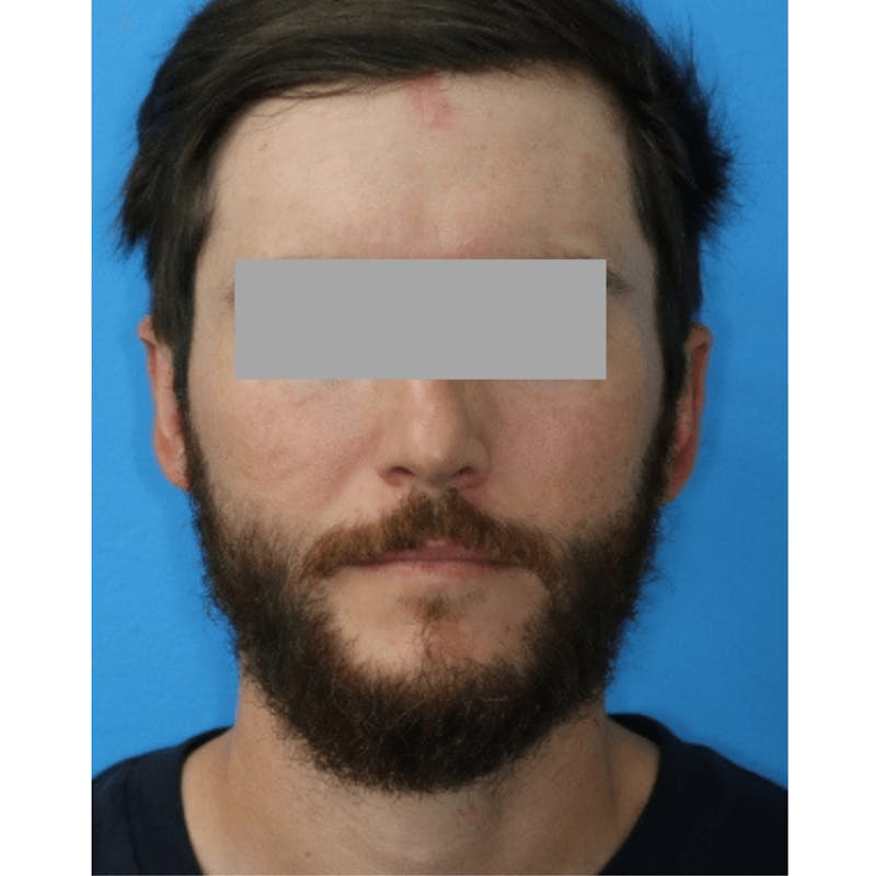 Ear Surgery Before & After Gallery - Patient 119278732 - Image 2