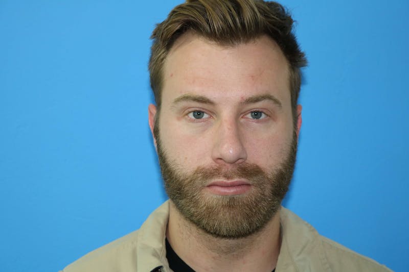Chin Augmentation Before & After Gallery - Patient 119278777 - Image 4
