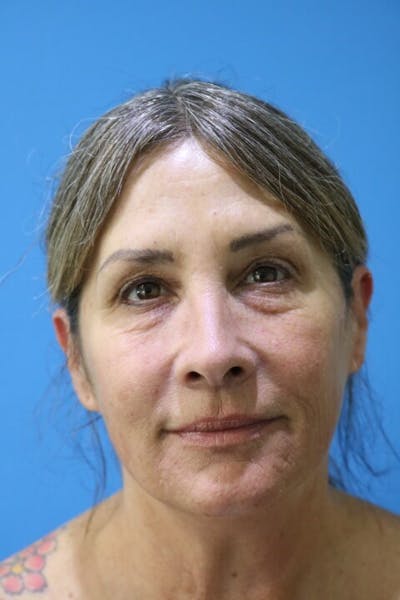 Eyelid Surgery Before & After Gallery - Patient 119278778 - Image 1