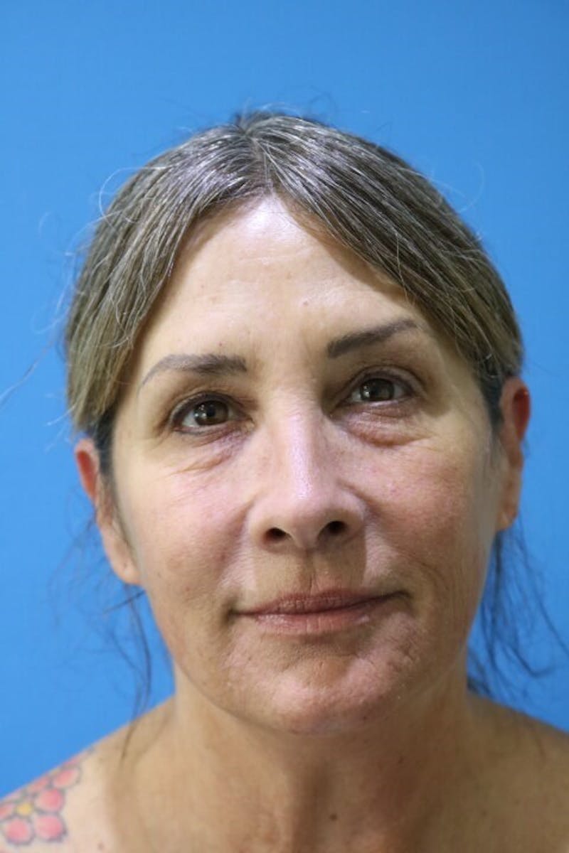 Eyelid Surgery Before & After Gallery - Patient 119278778 - Image 1