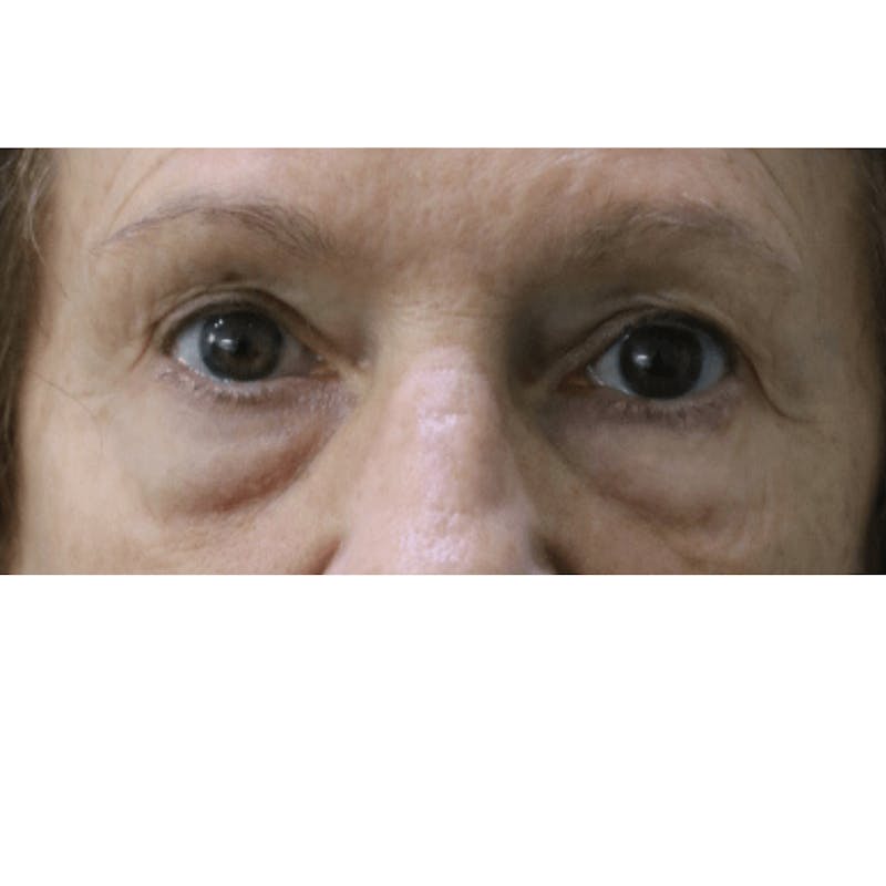 Eyelid Surgery Before & After Gallery - Patient 119278779 - Image 1