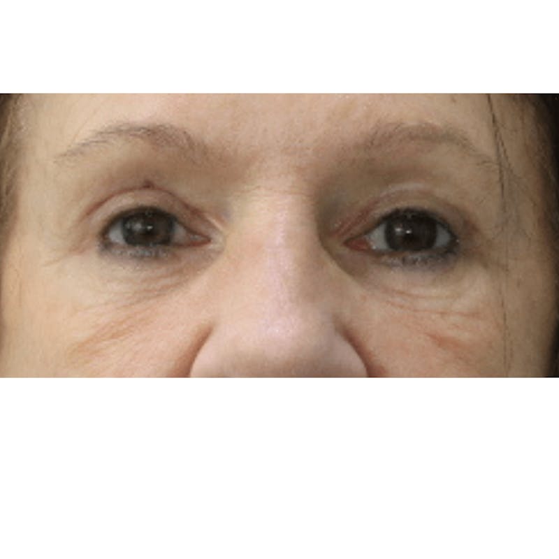 Eyelid Surgery Before & After Gallery - Patient 119278779 - Image 2