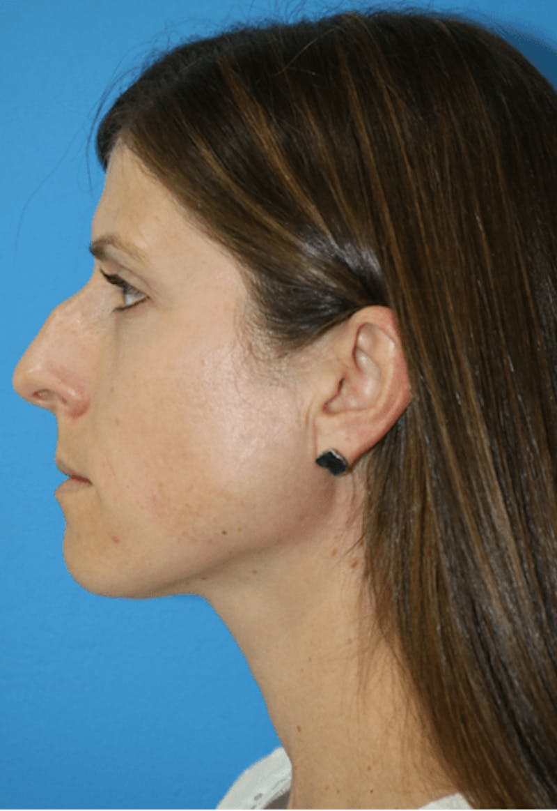 Rhinoplasty Before & After Gallery - Patient 119278780 - Image 1