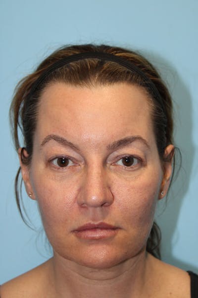 Eyelid Surgery Before & After Gallery - Patient 119278781 - Image 1