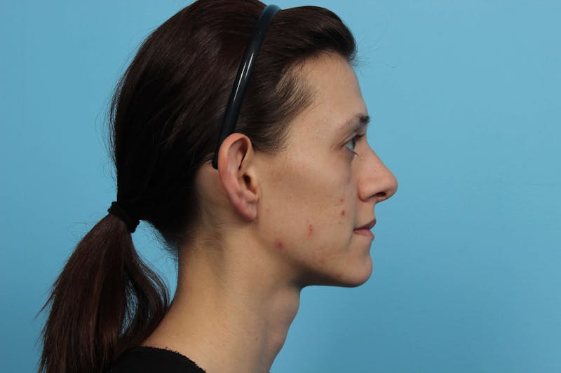 Ear Surgery Before & After Gallery - Patient 119278858 - Image 5