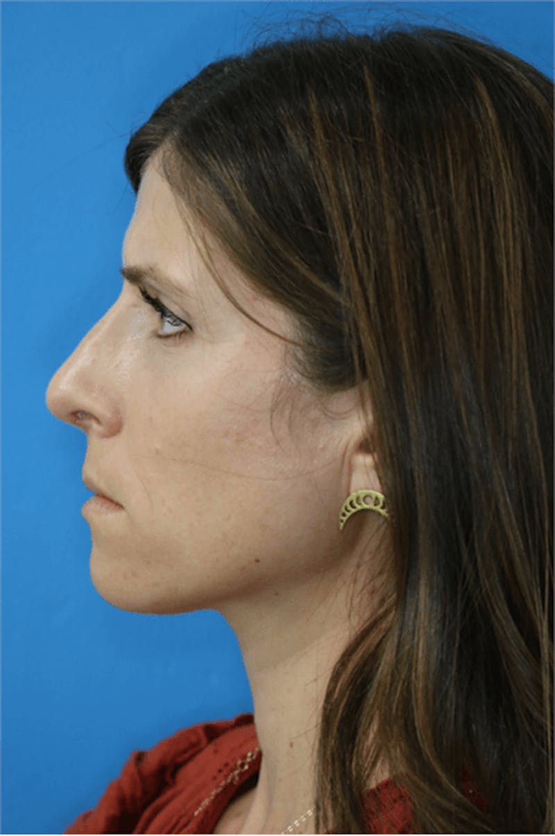 Rhinoplasty Before & After Gallery - Patient 119278780 - Image 2