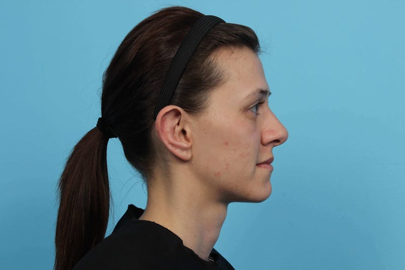 Ear Surgery Before & After Gallery - Patient 119278858 - Image 6