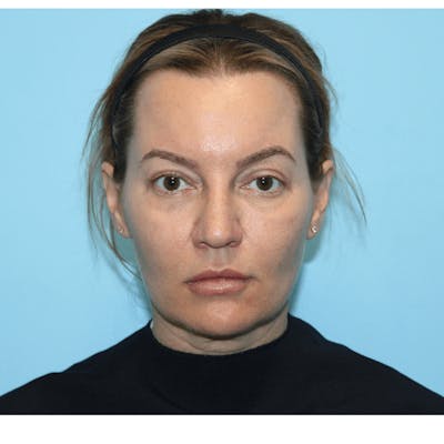 Eyelid Surgery Before & After Gallery - Patient 119278781 - Image 2