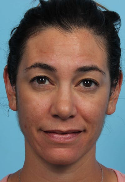 Chemical Peels Before & After Gallery - Patient 119278872 - Image 2