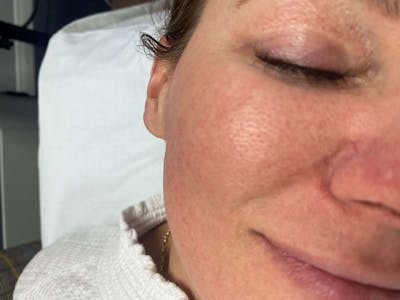 Dermaplaning Before & After Gallery - Patient 119278947 - Image 2