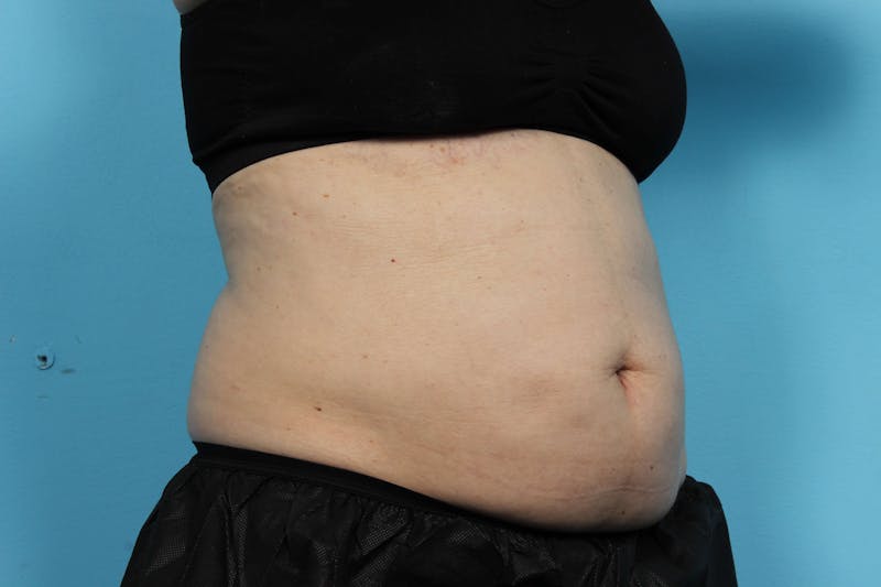 CoolSculpting Before & After Gallery - Patient 119278967 - Image 1