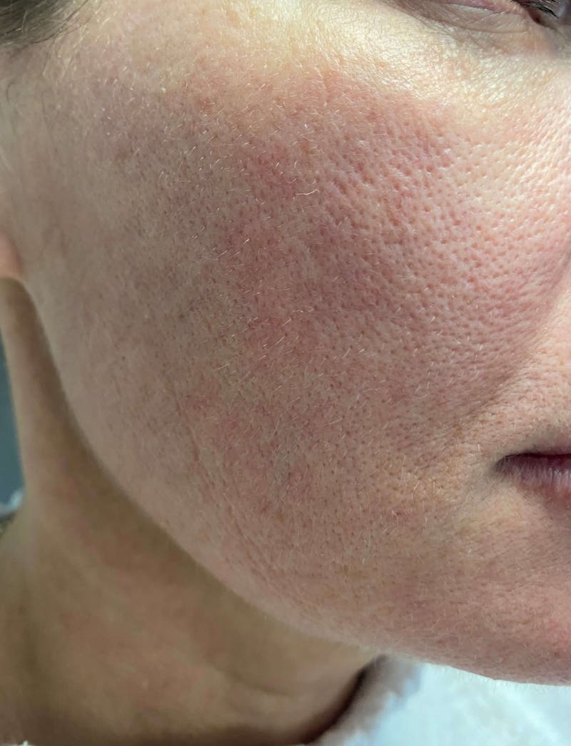 Dermaplaning Before & After Gallery - Patient 119278947 - Image 3