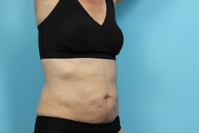 CoolSculpting Before & After Gallery - Patient 119278967 - Image 2