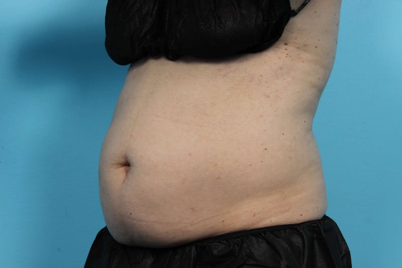 CoolSculpting Before & After Gallery - Patient 119278967 - Image 3