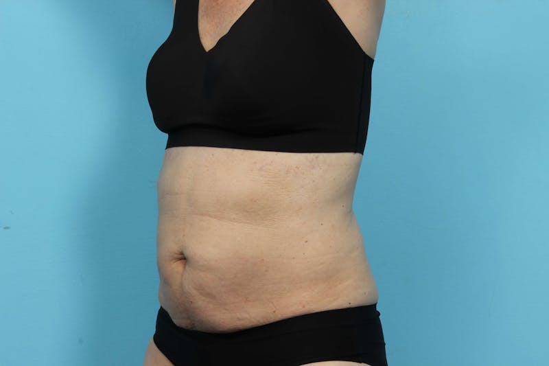 CoolSculpting Before & After Gallery - Patient 119278967 - Image 4