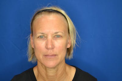 Skin Rejuvenation Before & After Gallery - Patient 119279076 - Image 1