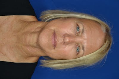 Skin Rejuvenation Before & After Gallery - Patient 119279076 - Image 2