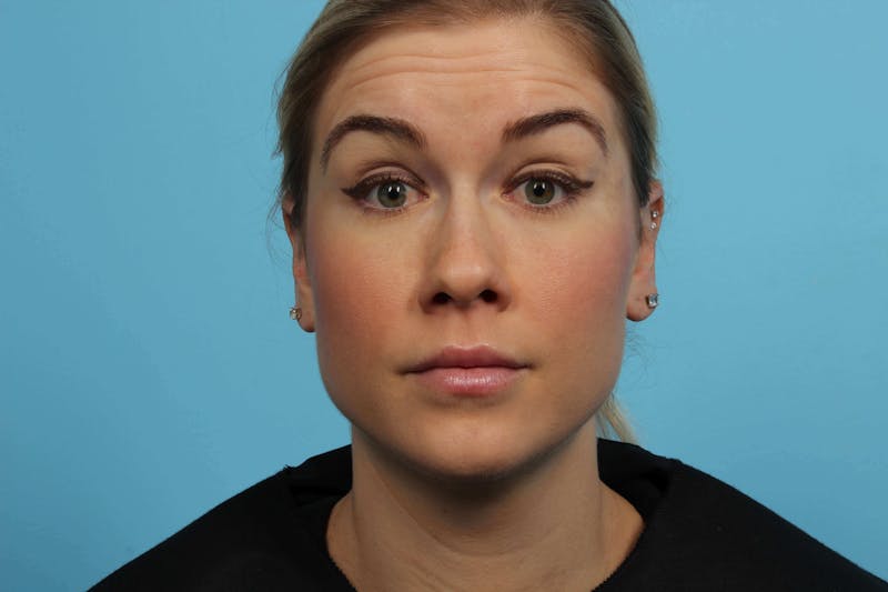 BOTOX<sup>®</sup> Before & After Gallery - Patient 119279118 - Image 1