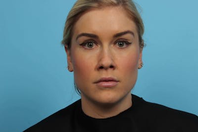 BOTOX<sup>®</sup> Before & After Gallery - Patient 119279118 - Image 2