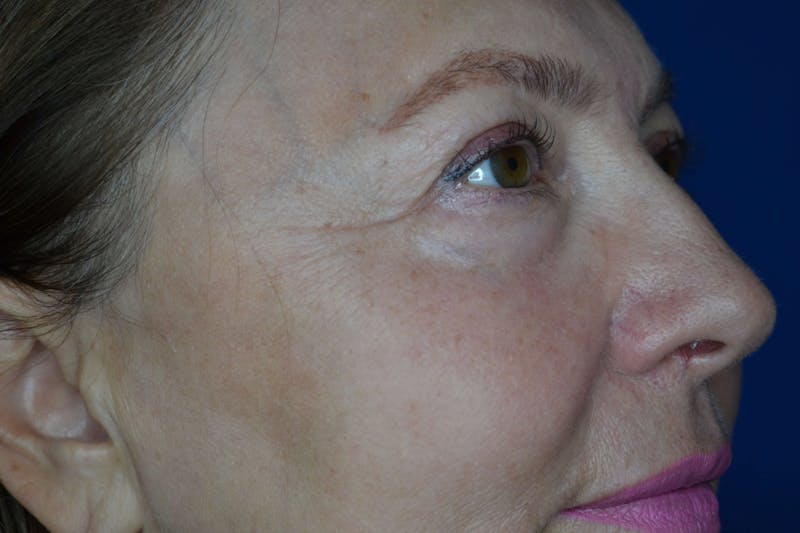 Skin Rejuvenation Before & After Gallery - Patient 119279119 - Image 3