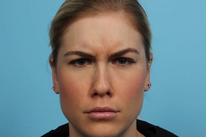 BOTOX<sup>®</sup> Before & After Gallery - Patient 119279120 - Image 1