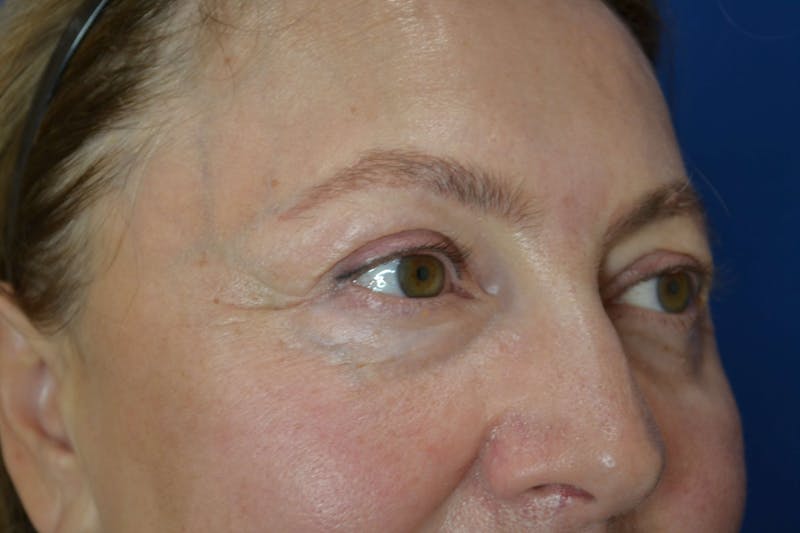 Skin Rejuvenation Before & After Gallery - Patient 119279119 - Image 4