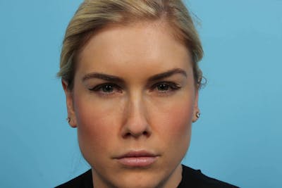 BOTOX<sup>®</sup> Before & After Gallery - Patient 119279120 - Image 2