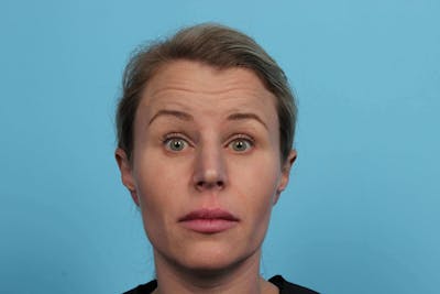 BOTOX<sup>®</sup> Before & After Gallery - Patient 119279155 - Image 1