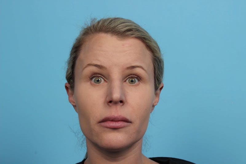 BOTOX<sup>®</sup> Before & After Gallery - Patient 119279155 - Image 2