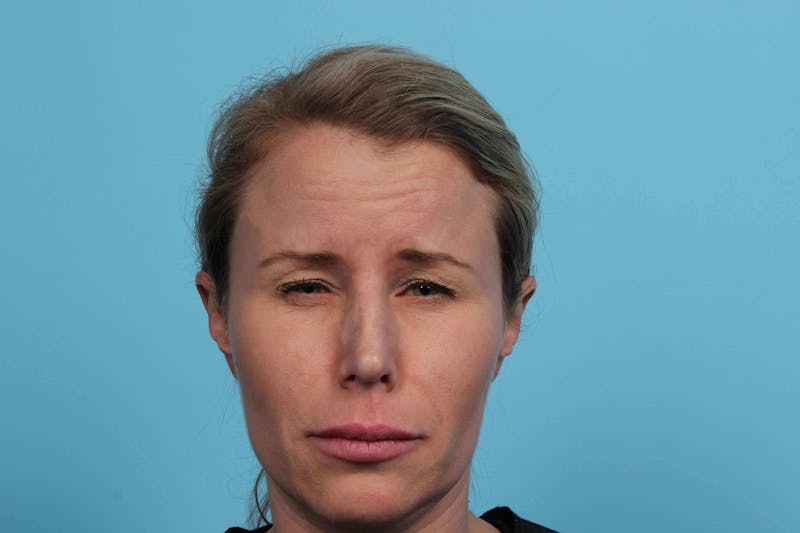 BOTOX<sup>®</sup> Before & After Gallery - Patient 119279191 - Image 1
