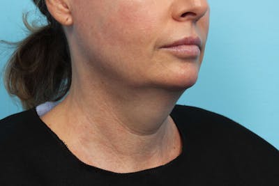 CoolSculpting Before & After Gallery - Patient 119279199 - Image 1