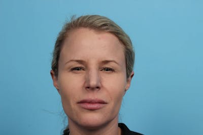 BOTOX<sup>®</sup> Before & After Gallery - Patient 119279191 - Image 2